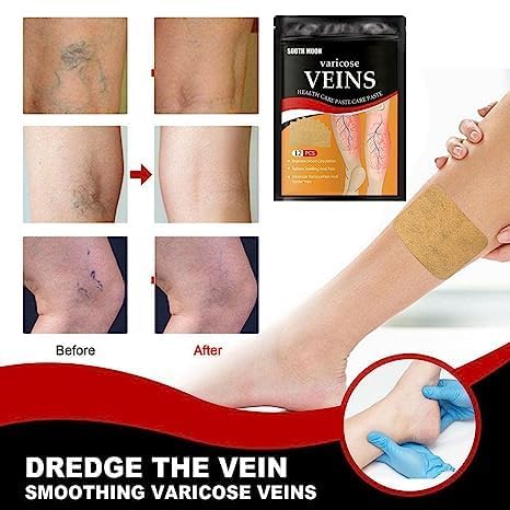 Turmeric Instant Relief Varicose Vein Patches(Buy 1 get 1 Free🔥)